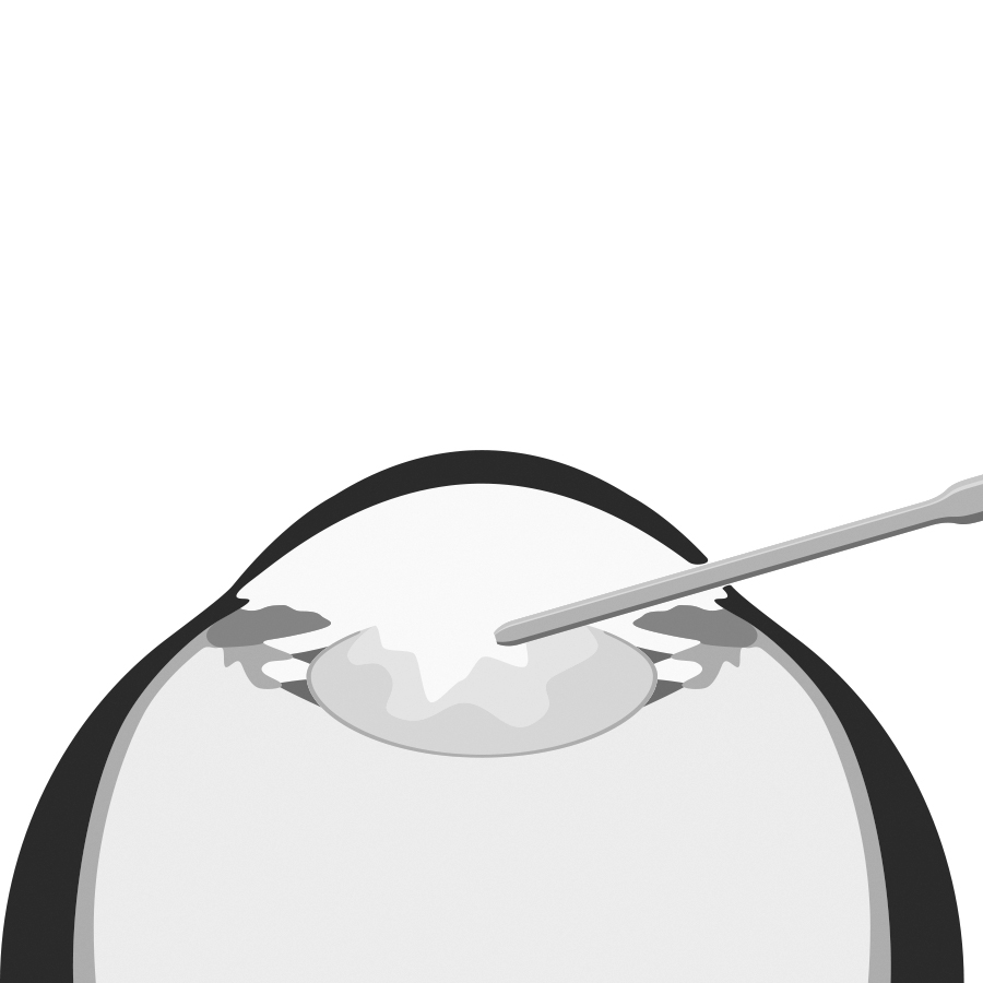 Refraktiver Linsentausch (RLA) bei Brillenfreiheit Dresden - Schritt 1