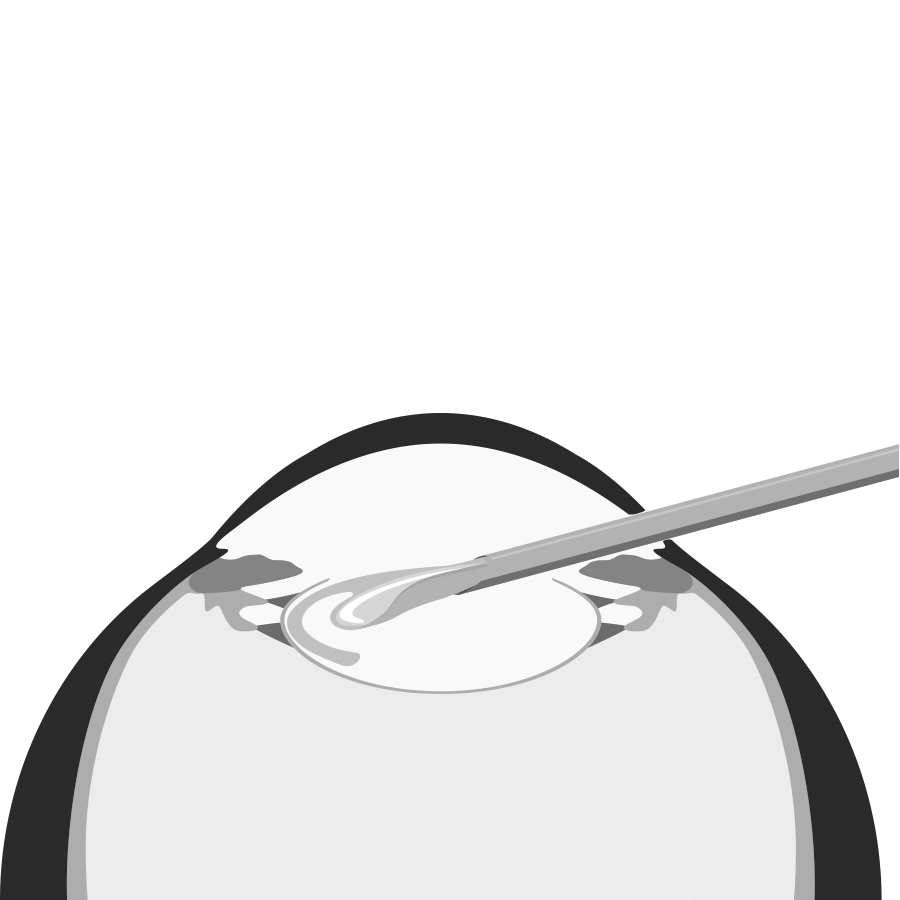 Refraktiver Linsentausch (RLA) bei Brillenfreiheit Dresden - Schritt 2