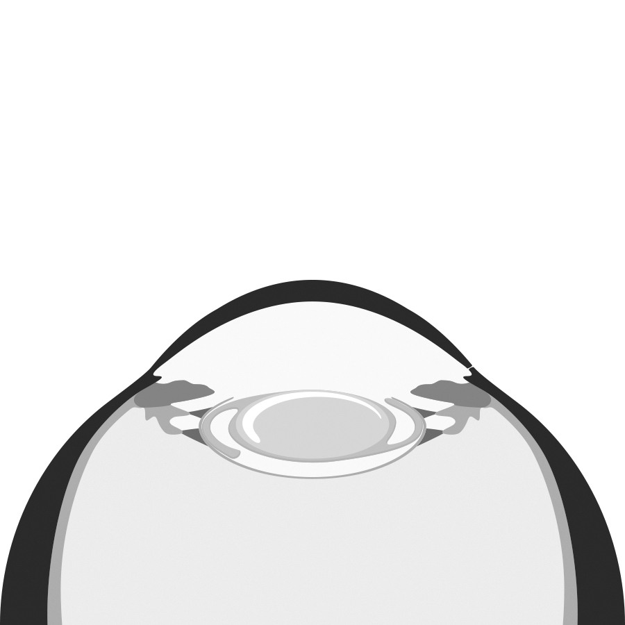 Refraktiver Linsentausch (RLA) bei Brillenfreiheit Dresden - Schritt 3